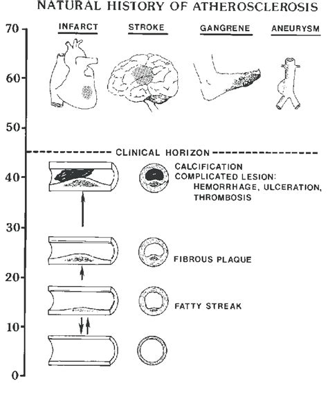 The development of the fatty streak in childhood is depicted as a... | Download Scientific Diagram