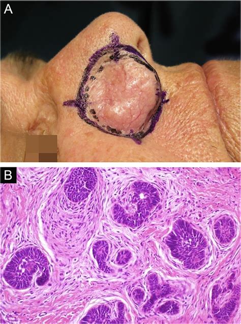Recurrent trichoblastoma. (A) (top image: clinical delimitation during ...
