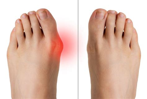 Bunion Removal Surgery in Palm Beach, Broward County, Florida