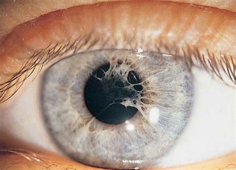 534 best Ocular Disease images on Pinterest | Optometry, Medicine and Eye