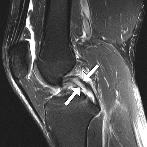 Tram-Track Appearance of the Posterior Cruciate Ligament (PCL): Correlations With Mucoid ...