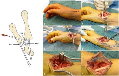 a Longitudinal skin incision of 3–4 cm over the thumb CMC joint between... | Download Scientific ...