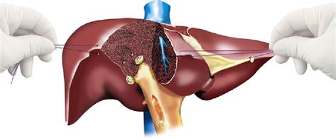 Hepatectomy, indications, technique & complications