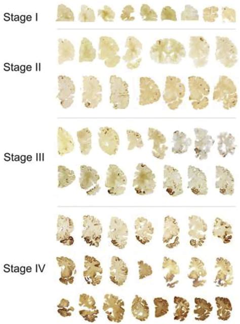 Stages of CTE. In stage I CTE, p-tau pathology is found in discrete ...