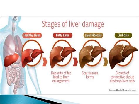 Cirrhosis As Related To Alcoholic Liver Disease Pictures