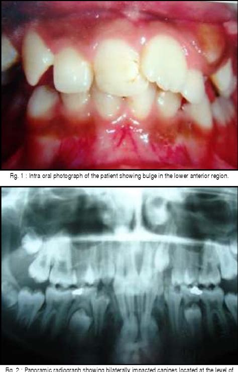 Figure 1 from Bilateral And Vertical Mandibular Canine Impaction In ...