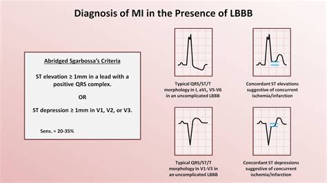 Ekg Interpretation Myocardial Infarction