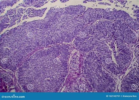 Bladder Transitional Cell Carcinoma, Light Micrograph Stock Image - Image of histology ...