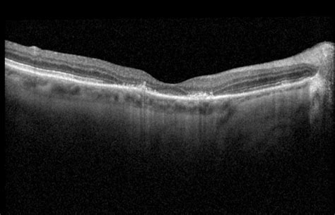 Plaquenil toxicity - Retina Image Bank