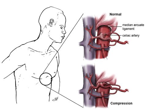 Why you should know about celiac artery compression syndrome