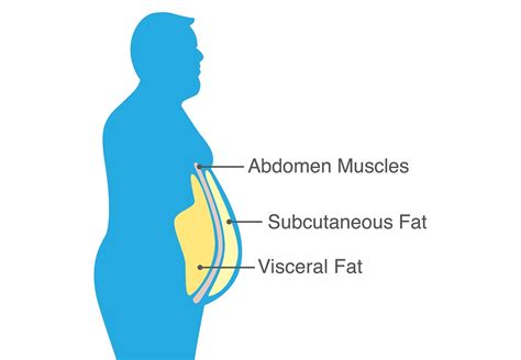 What Causes Visceral Fat? Addressing Symptoms