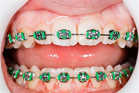 Top 5 Best fake braces that stick on your teeth prime for sale 2017 ...