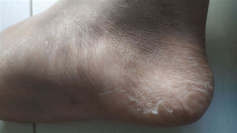 Dermatitis On Heel Of Foot on Sale | emergencydentistry.com