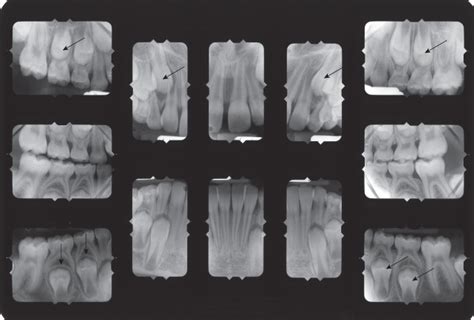 5 Radiographic Analysis | Pocket Dentistry