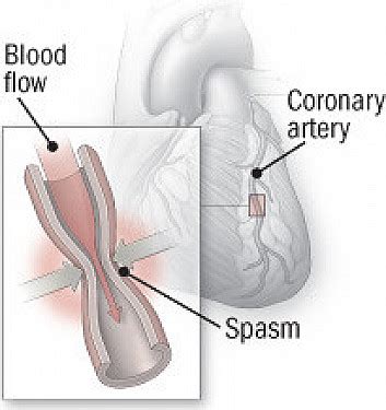 Coronary artery vasospasm - Harvard Health