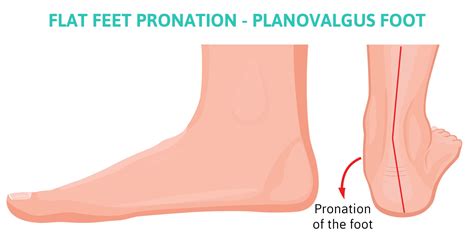 Flat Feet Pronation - Complications from Overpronation