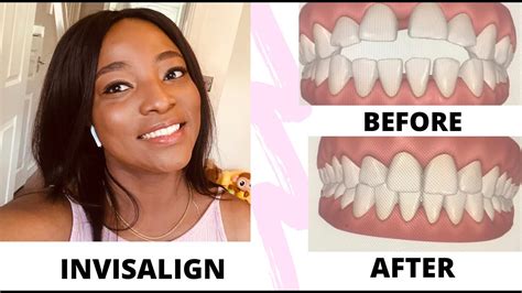 MY INVISALIGN REVIEW | BEFORE & AFTER PIC/VIDEO, COST, PAIN AND ...