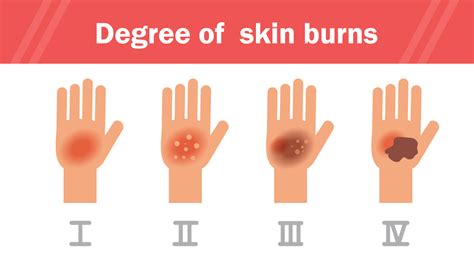 When to seek care for a burn | HCA Midwest | Turn4TheBetter