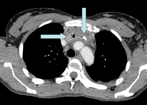 Extensive thrombophlebitis with gas associated with continuous infusion of vancomycin through a ...