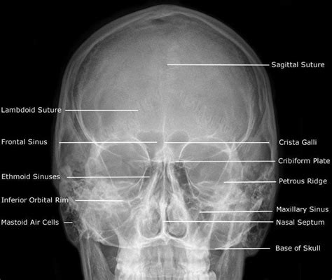 Radiographic Anatomy of Facial Bones » Am-Medicine | Facial bones, Radiology, Skull anatomy