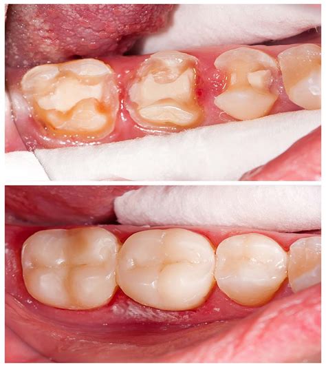 Dental Inlays and Onlays - Siam Station Dental Clinic