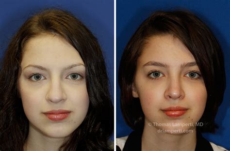 Bulbous Tip | Rhinoplasty in Seattle