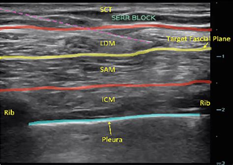 Serratus Anterior Plane Block for Thoracic Wall Pain - UCSD Ultrasound