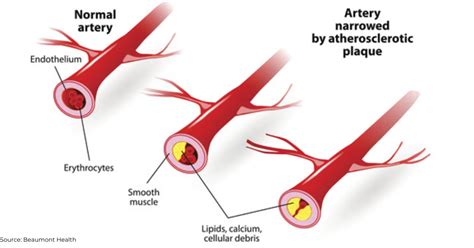 Coronary Calcium Scan | Manhattan Cardiology | Manhattan, NY