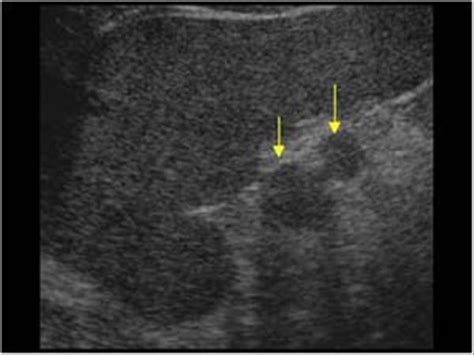 Abdomen and retroperitoneum | 1.4 Spleen : Case 1.4.6 Accessory spleens and other variants ...