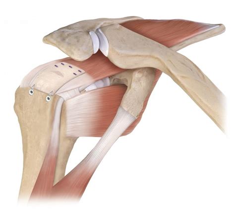 How are muscles affected in a reverse total shoulder replacement ...