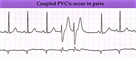 Ecg_couplet PVC | Physical therapy, Therapy, Health care