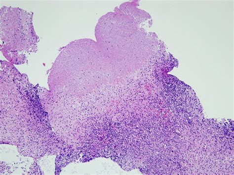 Biopsy of the mastoid antrum. Histopathologic finding of mastoid antrum ...