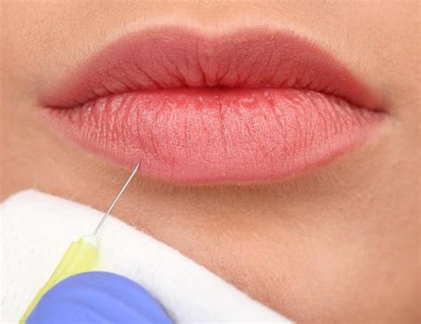 How Long do Collagen Injections Last? (with pictures)