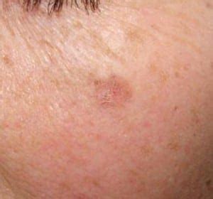 Actinic Keratosis - Dermatology Care of Charlotte