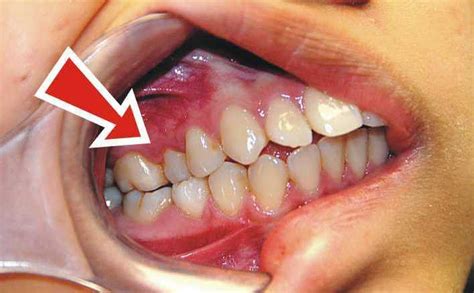 What is a Crossbite? - Ask an Orthodontist.com