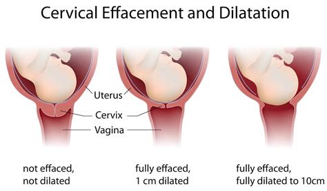 Cervical effacement, cervix thinning & signs your cervix is thinning