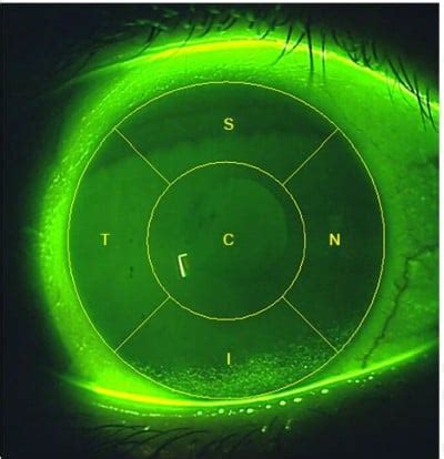 A novel scale for describing corneal staining | OPTH