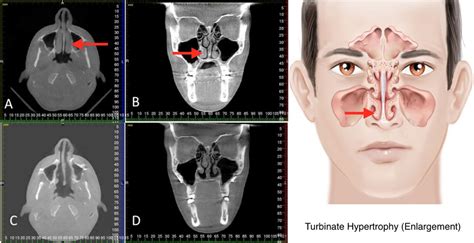 Nasal Obstruction Causes, Signs and Symptoms