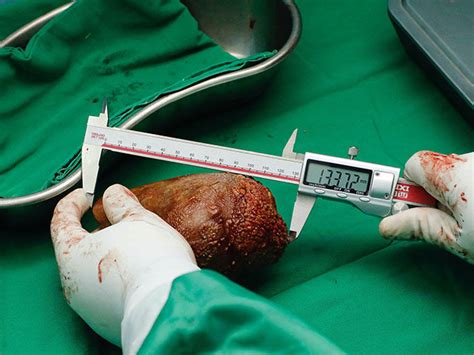 WATCH: Doctors Remove World's Largest Kidney Stone