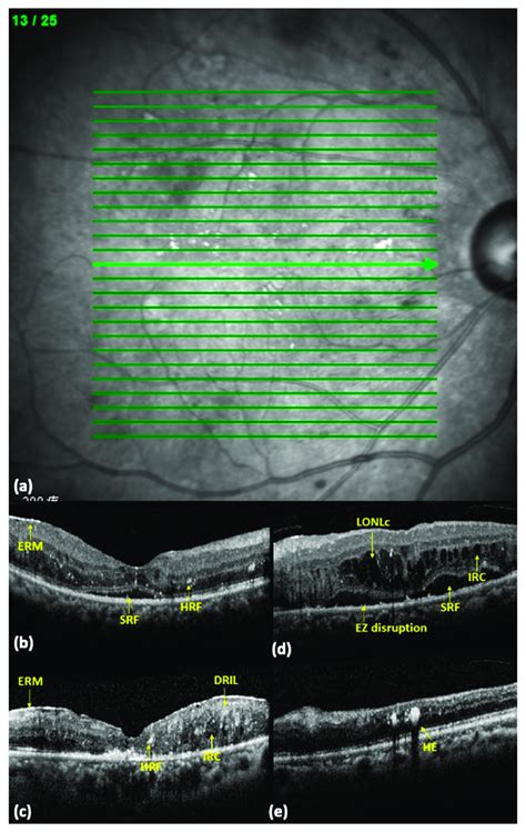 OCT biomarkers in diabetic macular edema (DME) eyes. (a) A ...