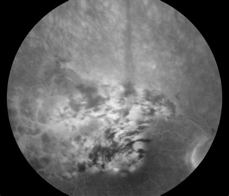 BRVO, Branch Retinal Vein Occlusion, BRVO Eye, BRVO Treatment