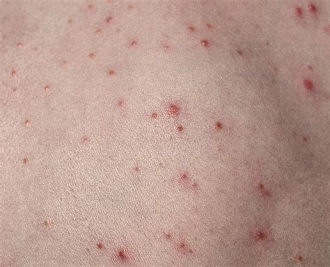 Is Your Acne Really Hidradenitis Suppurativa?