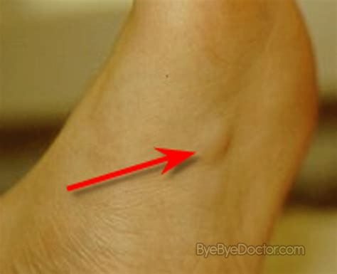 Plantar Fibromatosis – Symptoms, Causes, Pictures, Treatment | Symptoms ...