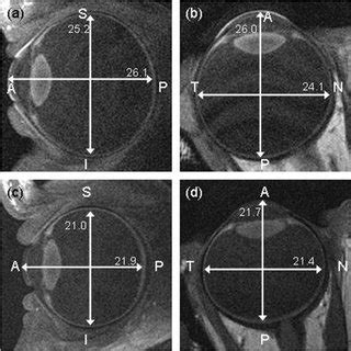 (PDF) Eye Shape in Emmetropia and Myopia