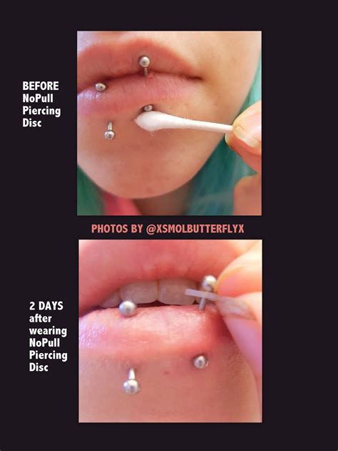 Hypertrophic Scar Nose Piercing