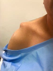 AC Joint Separation Recovery Time, Shoulder Separation | Dr. Steven Struhl NYC