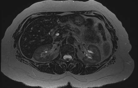 Insulinoma | Image | Radiopaedia.org