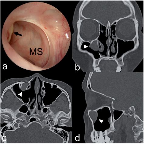 Maxillary Sinus Inverted Papilloma | Semantic Scholar