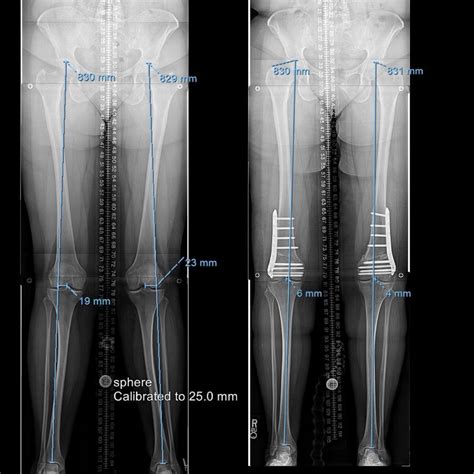 Before & After Photos - Limb Lengthening | Limb, Doctor in, Case histories