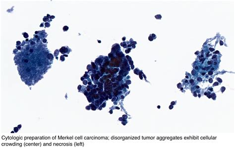 Pathology Outlines - Merkel cell carcinoma